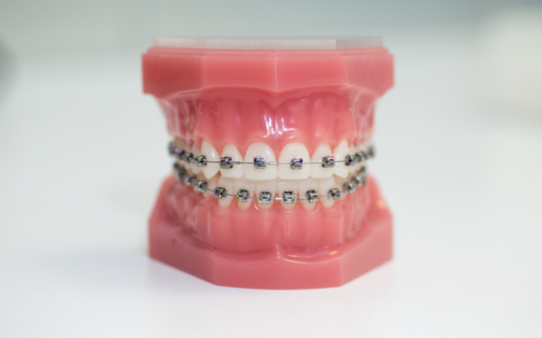 Key Factors That Make the Best Braces in Singapore